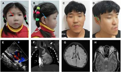 A Chinese family with cat eye syndrome and abnormality of eye movement: First case report